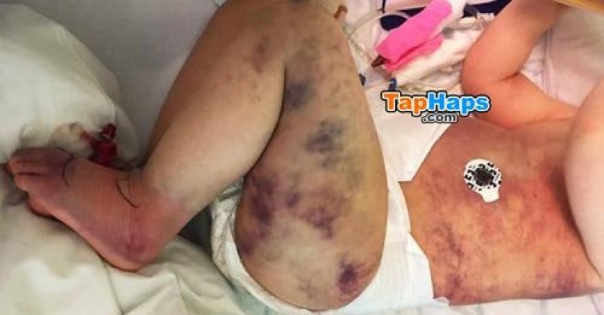 Mom Wrongly Believes Her Son Got Stung By Wasp His Body Turns Blue