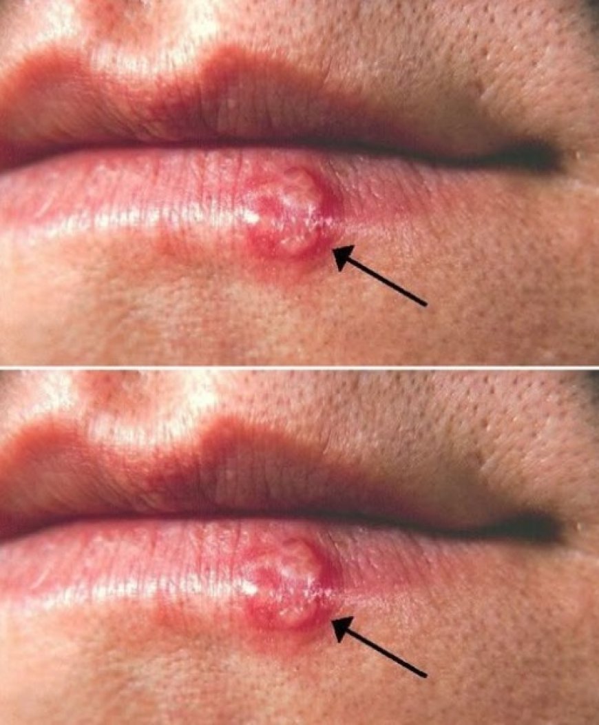 Most People Have Had or Have This Cold Sore Virus But Very Few Know How to Cure It Here What You Need to Do
